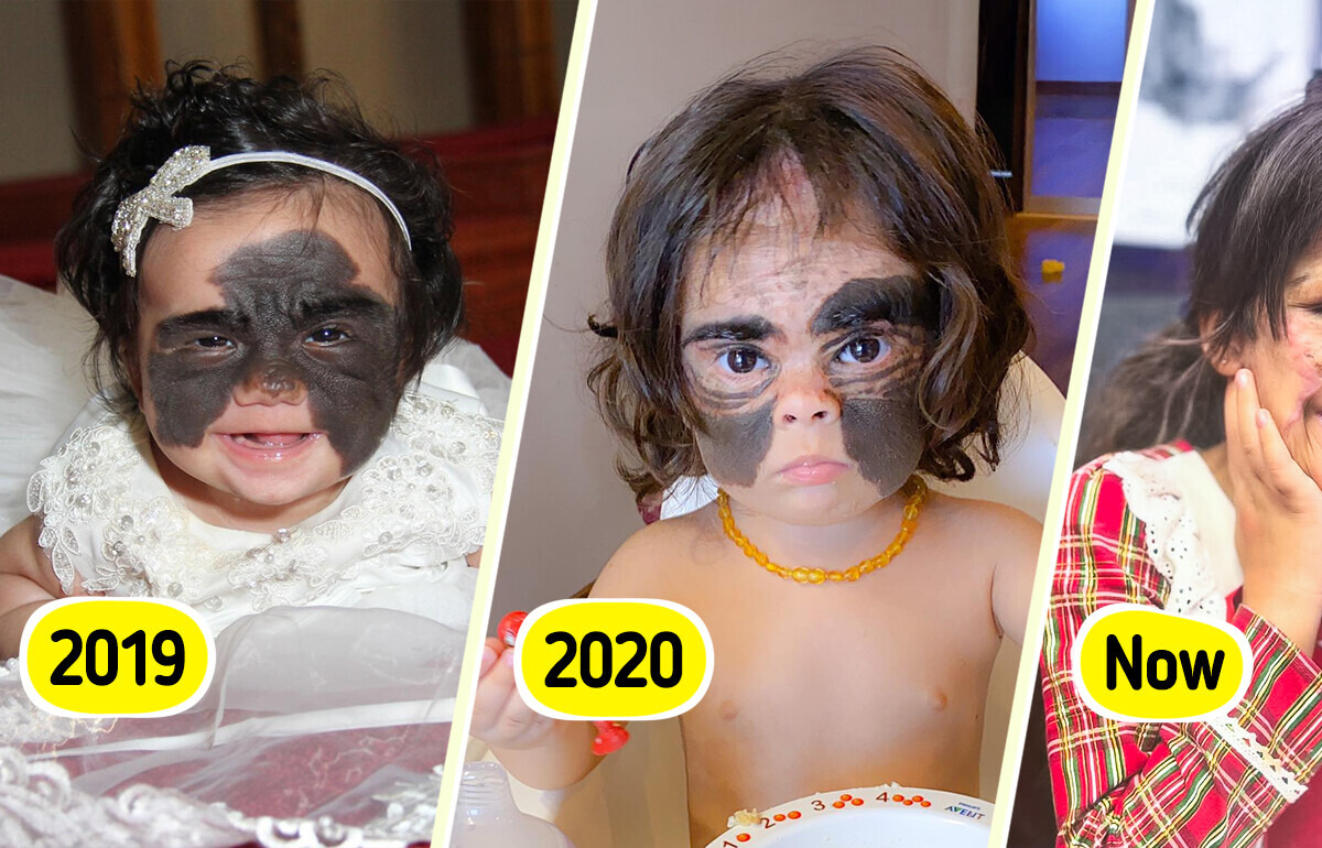 Girl Was Called “Monster” for Her “Batman” Birthmark — Now She Looks Completely Unrecognizable