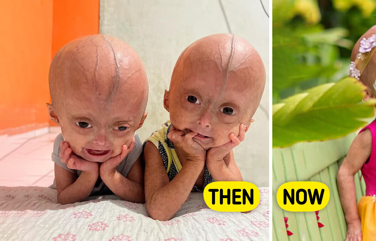 Meet The Benjamin Button Twins Who Captured People’s Hearts