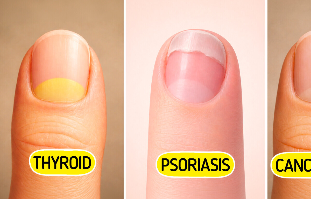 These Nail Changes May Be Early Signs of Serious Diseases