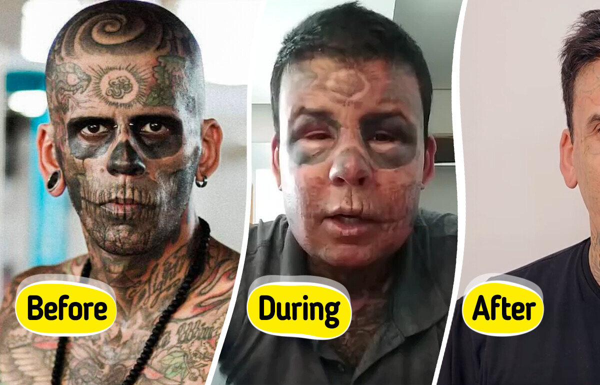 Man Who Had 95% of His Body Tattooed Reveals Stunning Results of Removal Surgery