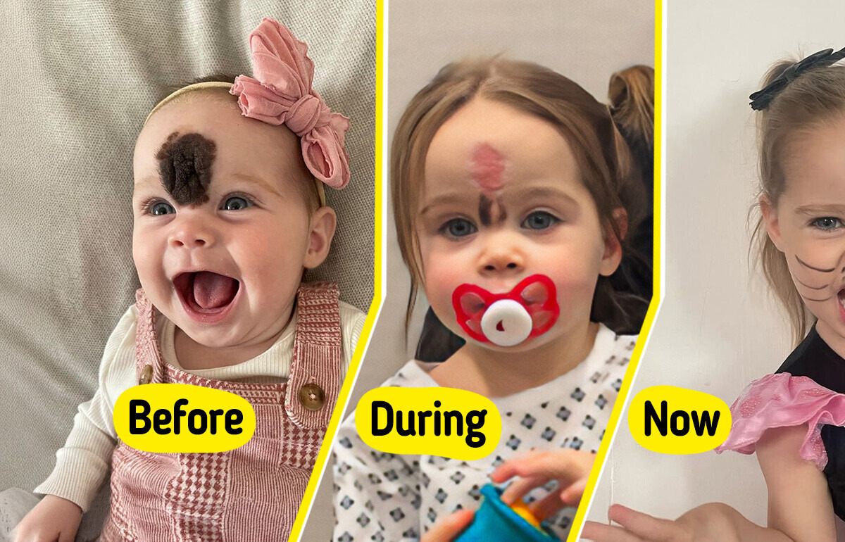 “We Got Stares,” Parents Chose to Remove Their Daughter’s Rare Birthmark to Prevent Teasing “We Got Stares,” Parents Chose to Remove Their Daughter’s Rare Birthmark to Prevent Teasing