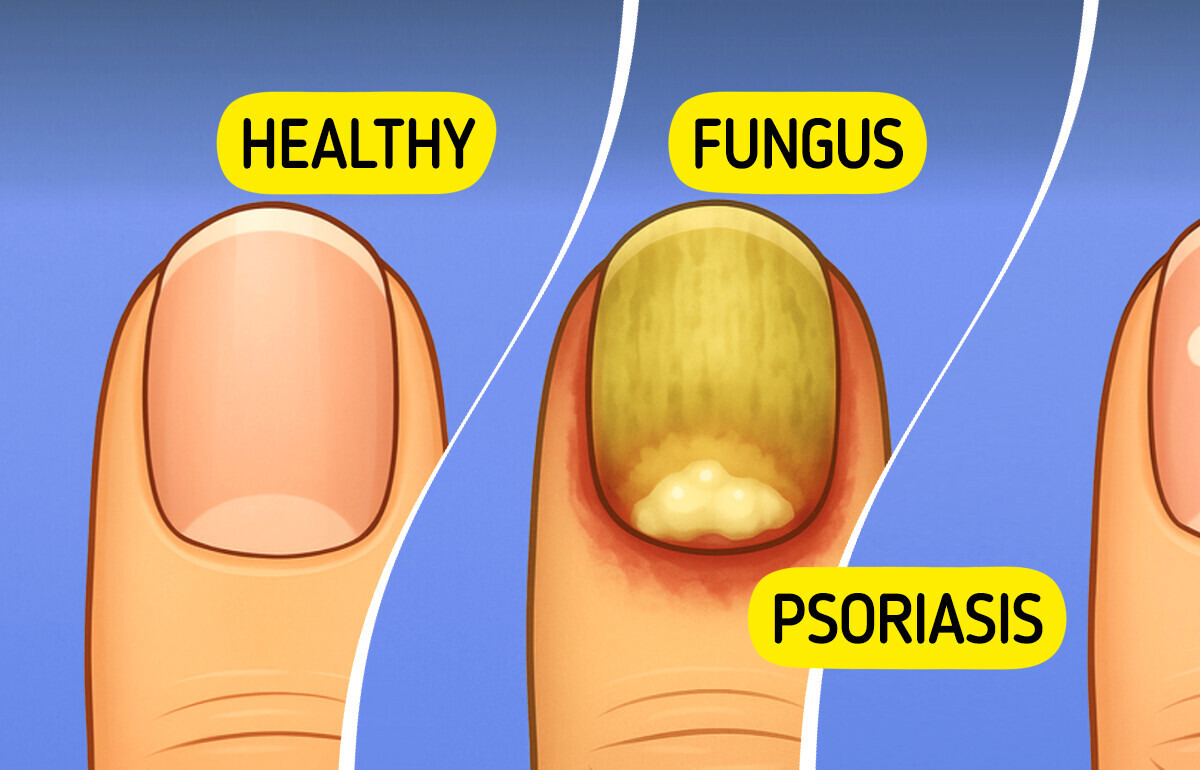 8 Silent Everyday Triggers That Could Be Fueling Psoriasis 8 Silent Everyday Triggers That Could Be Fueling Psoriasis
