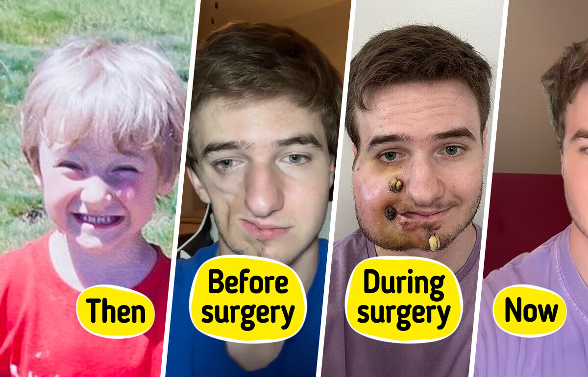 Meet Lukas: His Journey with Parry-Romberg Syndrome and How He Looks Today Meet Lukas: His Journey with Parry-Romberg Syndrome and How He Looks Today