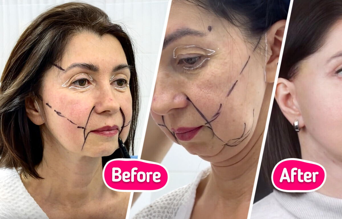 “She Looks 20 Years Younger!” Woman, 49, Leaves People Speechless After Revealing Surgery Results