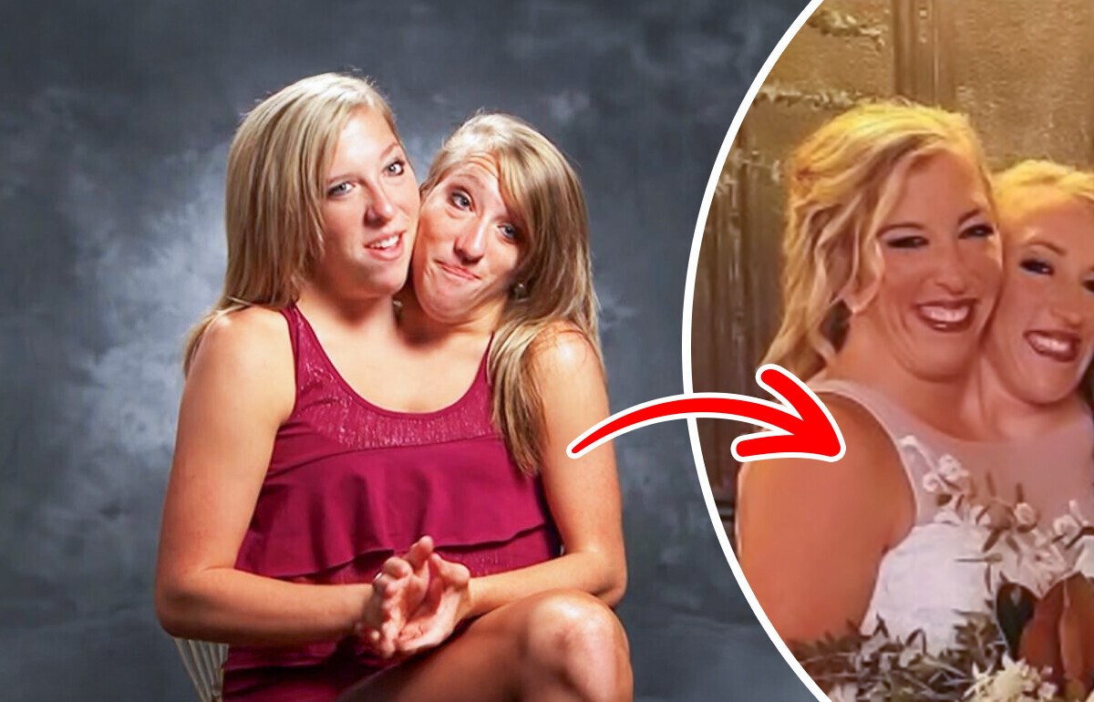 “I’m Just Confused!” One of the Famous Conjoined Twins Got Married, Sparking Heated Controversy “I’m Just Confused!” One of the Famous Conjoined Twins Got Married, Sparking Heated Controversy