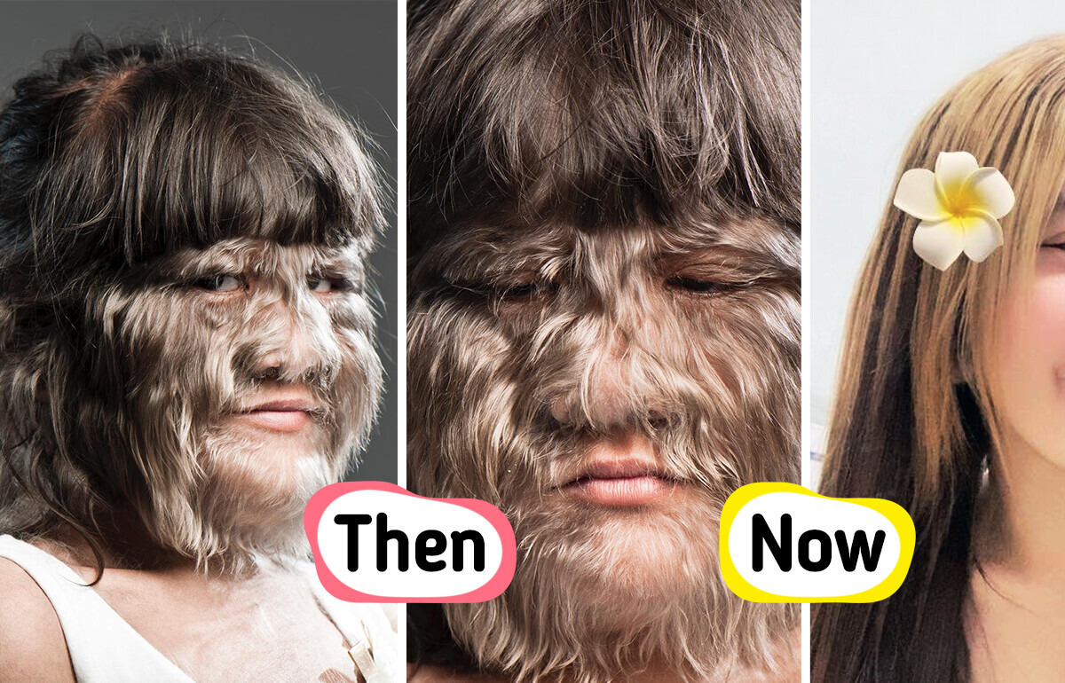 “World’s Hairiest Girl” Reveals Astonishing New Look — Fully Grown and Madly in Love “World’s Hairiest Girl” Reveals Astonishing New Look — Fully Grown and Madly in Love