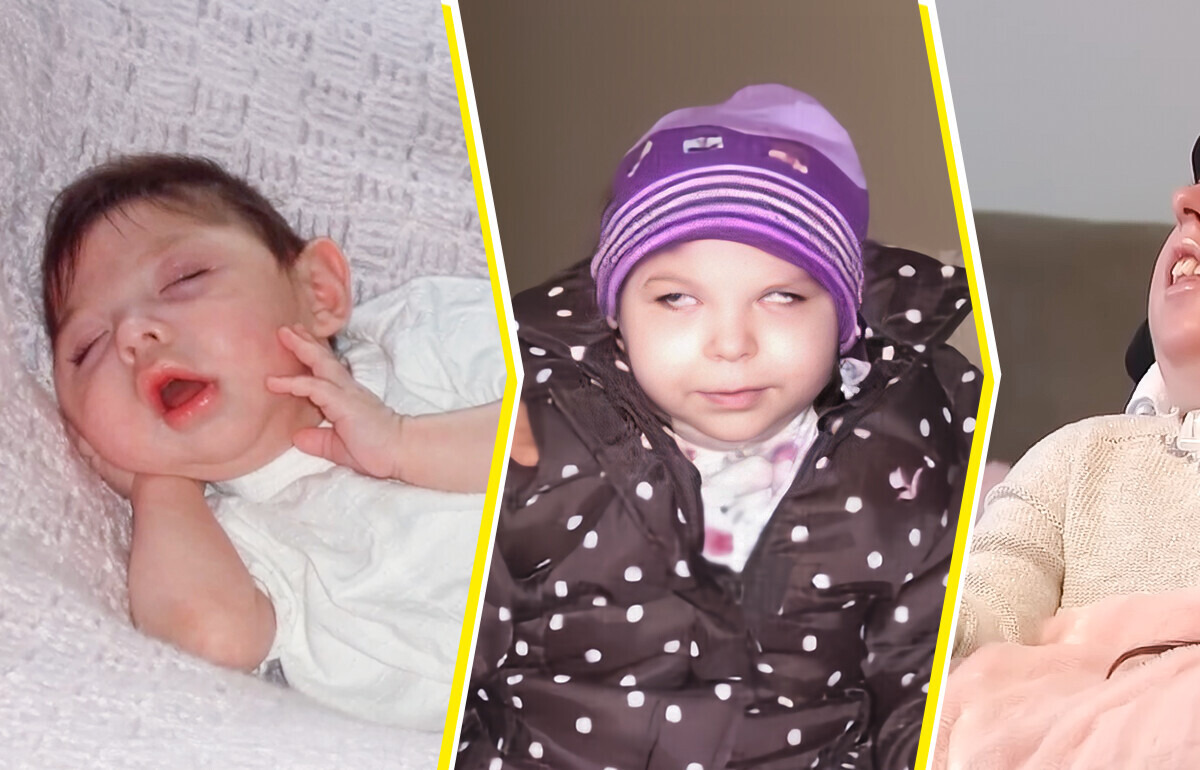 She Was Born Without a Brain and Given Only 4 Years to Live — but She Turned 20 Against All Odds