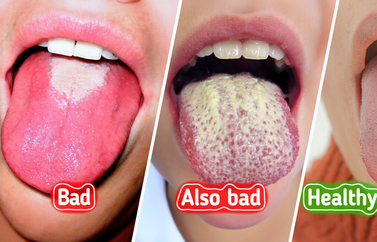 What a White Tongue May Reveal About Your Health — and How to Treat It Naturally