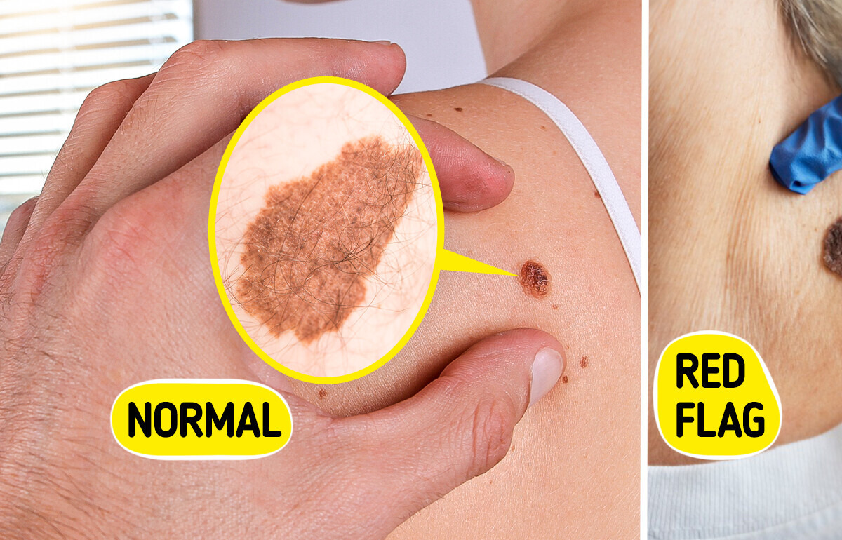 5 Alarming Signs Your Moles Could Be Deadly Skin Cancer 5 Alarming Signs Your Moles Could Be Deadly Skin Cancer