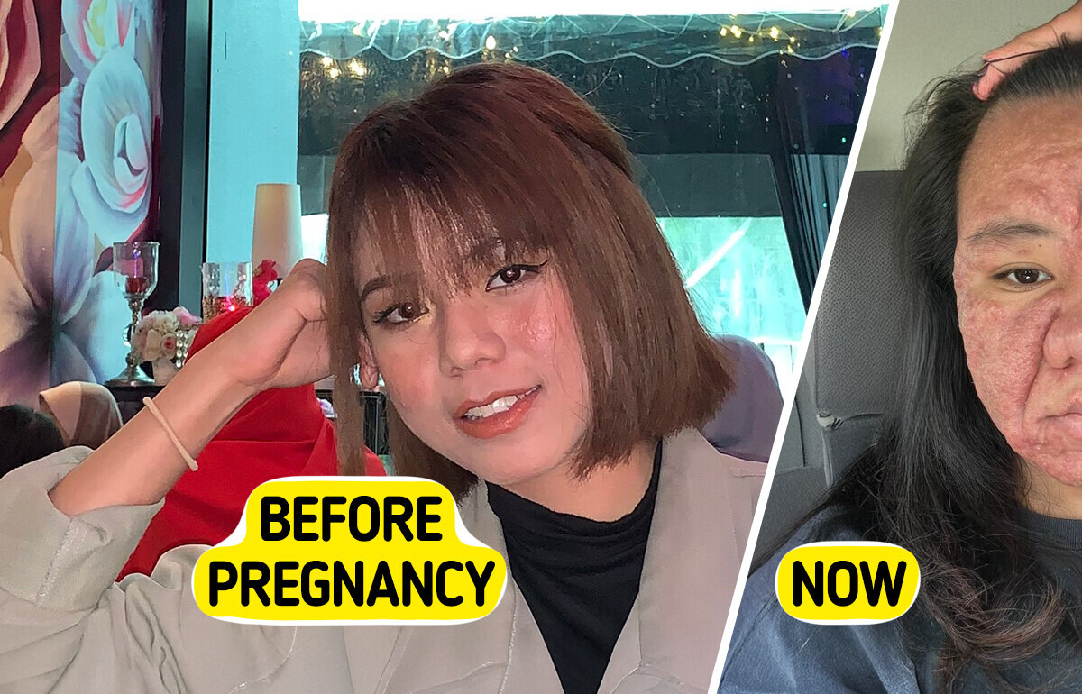 28-Year-Old Woman Shares Shocking Pregnancy Face Transformation With Full Honesty 28-Year-Old Woman Shares Shocking Pregnancy Face Transformation With Full Honesty