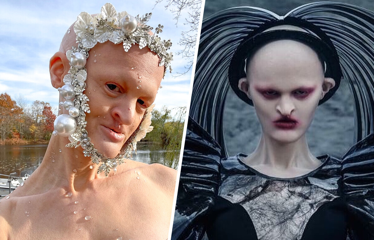 Meet the Model With a Rare Genetic Disorder Who Proves Beauty Has No Rules Meet the Model With a Rare Genetic Disorder Who Proves Beauty Has No Rules