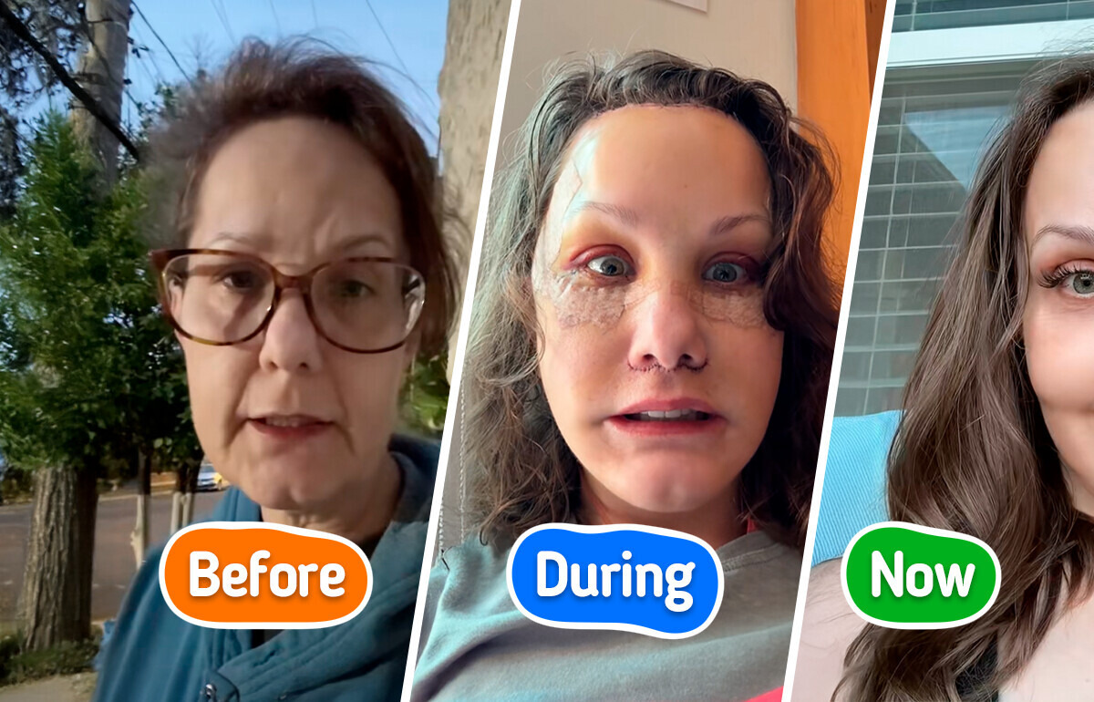 Woman, 50, Reveals Plastic Surgery Results, Leaving People Speechless With Her Strikingly Youthful Look Woman, 50, Reveals Plastic Surgery Results, Leaving People Speechless With Her Strikingly Youthful Look