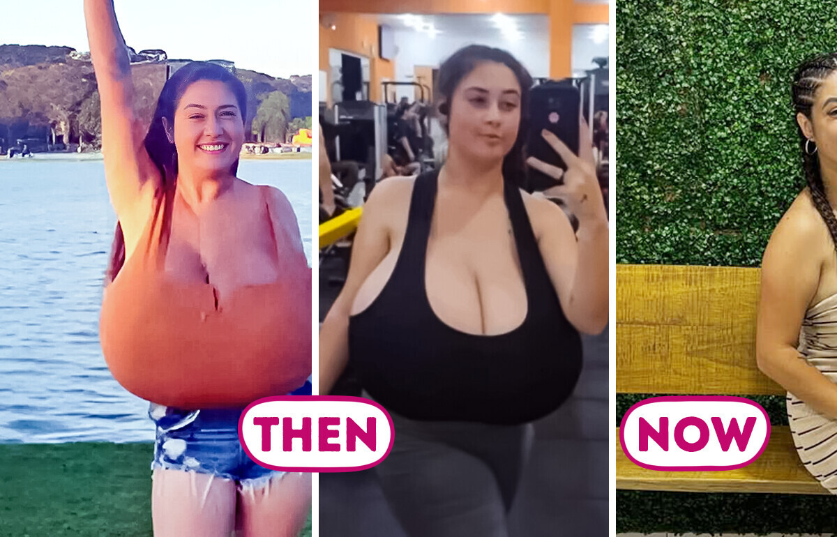 Girl Undergoes Surgery to Reduce 22-Pound Breasts, Revealing the Harsh Reality of Gigantomastia