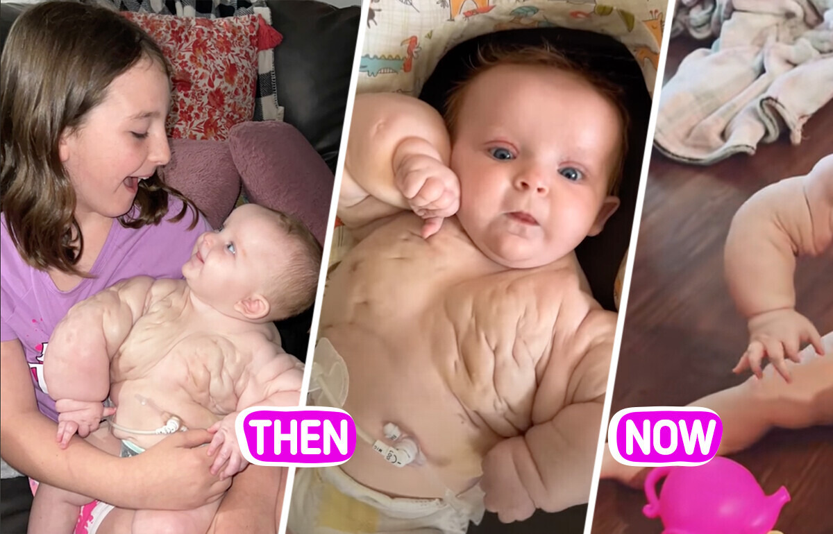 Meet “Baby Hulk,” the Newborn Girl Who Survived Against All Odds to Amaze Doctors