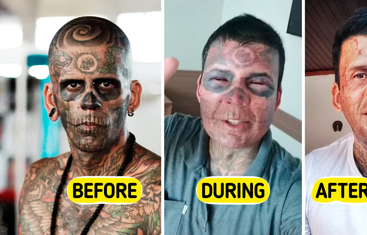 95% Tattooed Man REMOVES His Ink — The Transformation Is Unreal 95% Tattooed Man REMOVES His Ink — The Transformation Is Unreal