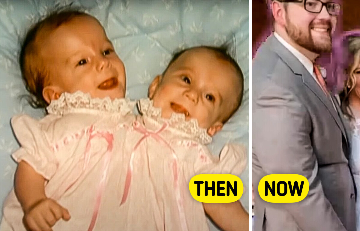 People React One of the Conjoined Twins’ Secret Wedding Sparked Curiosity Around the World People React One of the Conjoined Twins’ Secret Wedding Sparked Curiosity Around the World