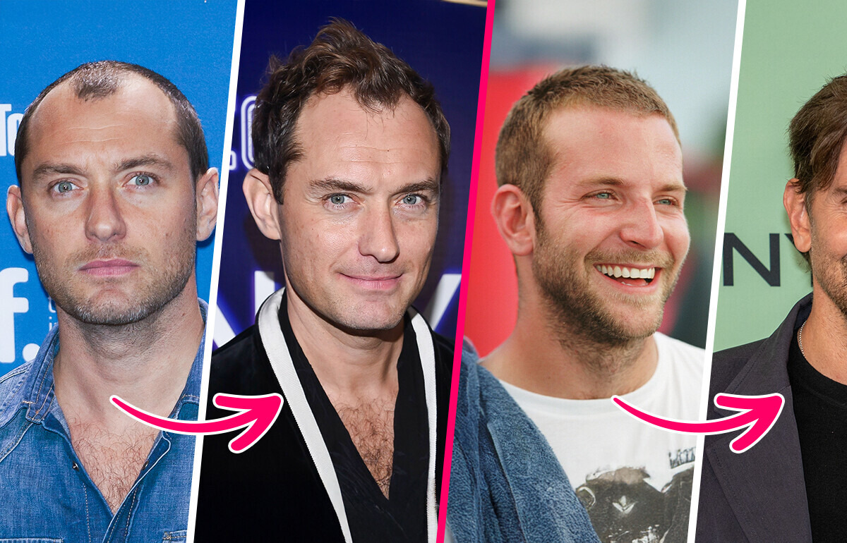 12 Celebrity Heartthrobs Before and After They Allegedly Got Hair Transplants