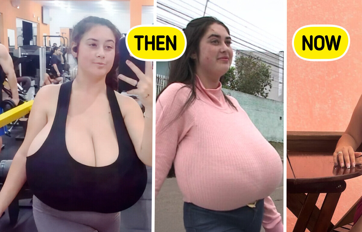10kg Breasts Forced a 22-Year-Old Student Into Life-Changing Surgery