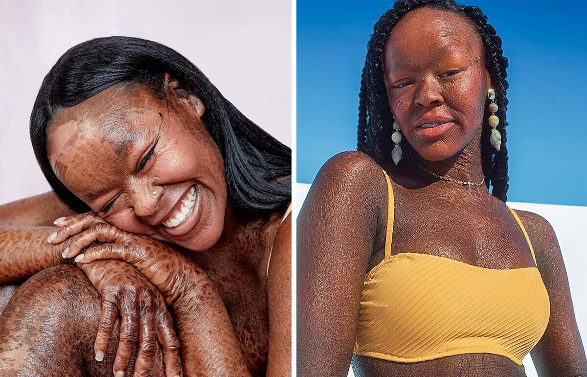 “I’m Allowed to Be Beautiful,” a Model With a Rare Skin Disorder Challenges the Beauty Industry
