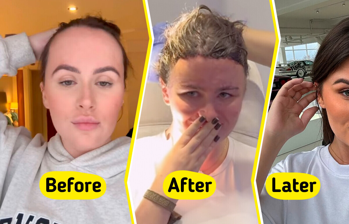 A Woman Who Faced Years of Mocking Over Her Forehead Undergoes Surgery to Reduce It A Woman Who Faced Years of Mocking Over Her Forehead Undergoes Surgery to Reduce It