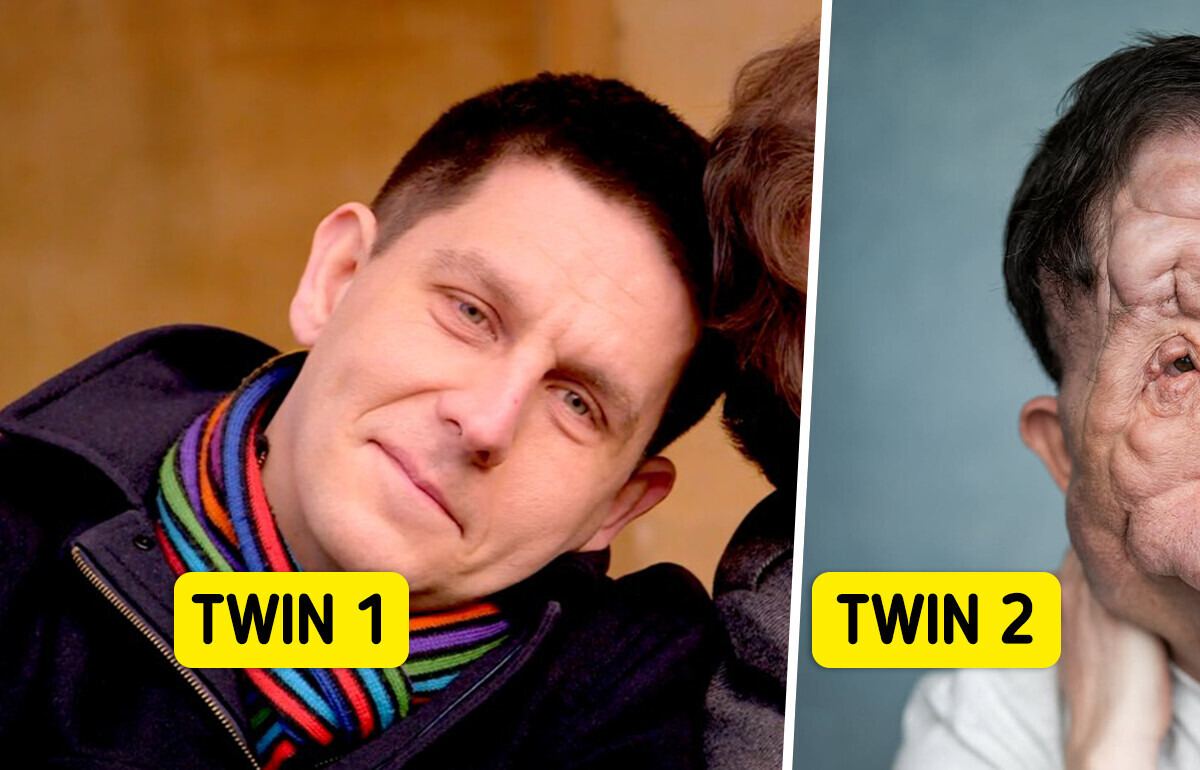 “No One Believes We’re Twins!” Rare Disorder Completely Reshaped This Man’s Face “No One Believes We’re Twins!” Rare Disorder Completely Reshaped This Man’s Face