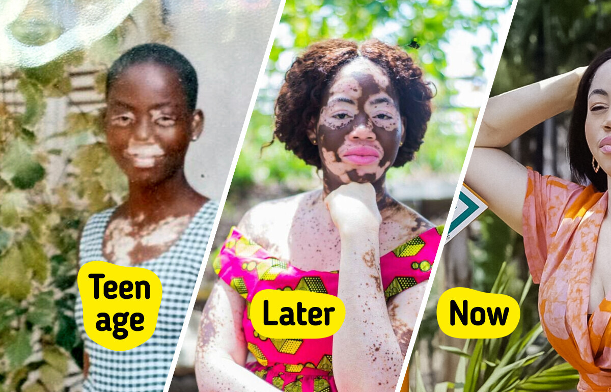 Meet the “Chameleon” Woman Who Turns Her Unique Beauty Into Inspiration
