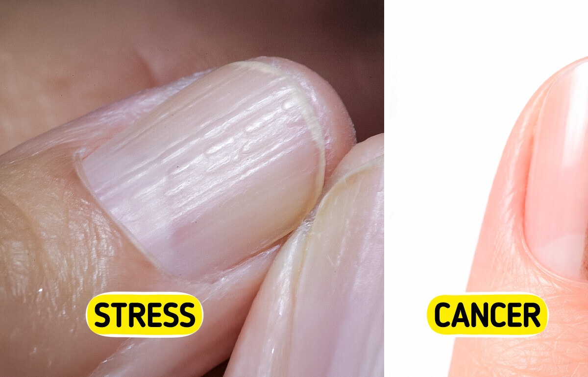 5 Serious Health Issues Your Nails Might Be Warning You About