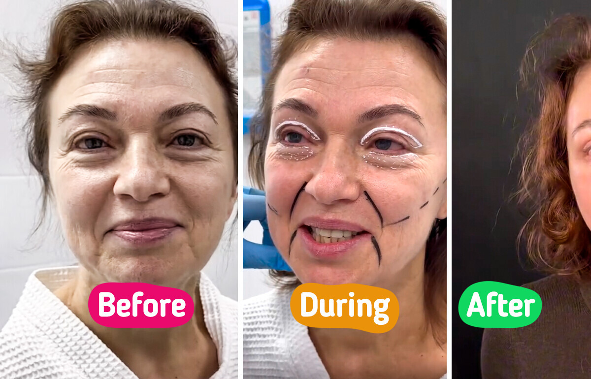 “She Needs to Change Her Passport” Woman, 58, Leaves People Speechless with Dramatic Facelift Results