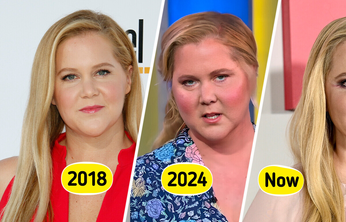 Amy Schumer Reveals That Internet Users Helped Her Find the Cause of Her “Moon Face” Amy Schumer Reveals That Internet Users Helped Her Find the Cause of Her “Moon Face”