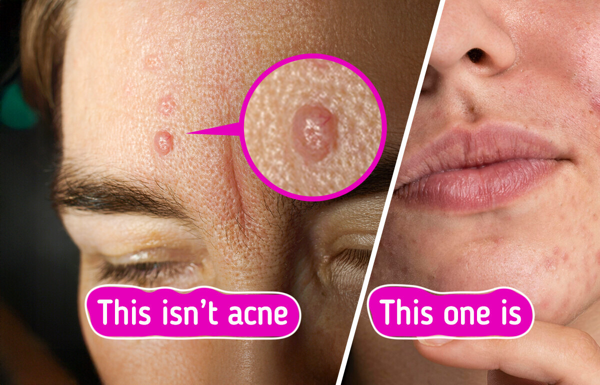 7 Skin Bumps You’re Probably Mistaking for Acne 7 Skin Bumps You’re Probably Mistaking for Acne