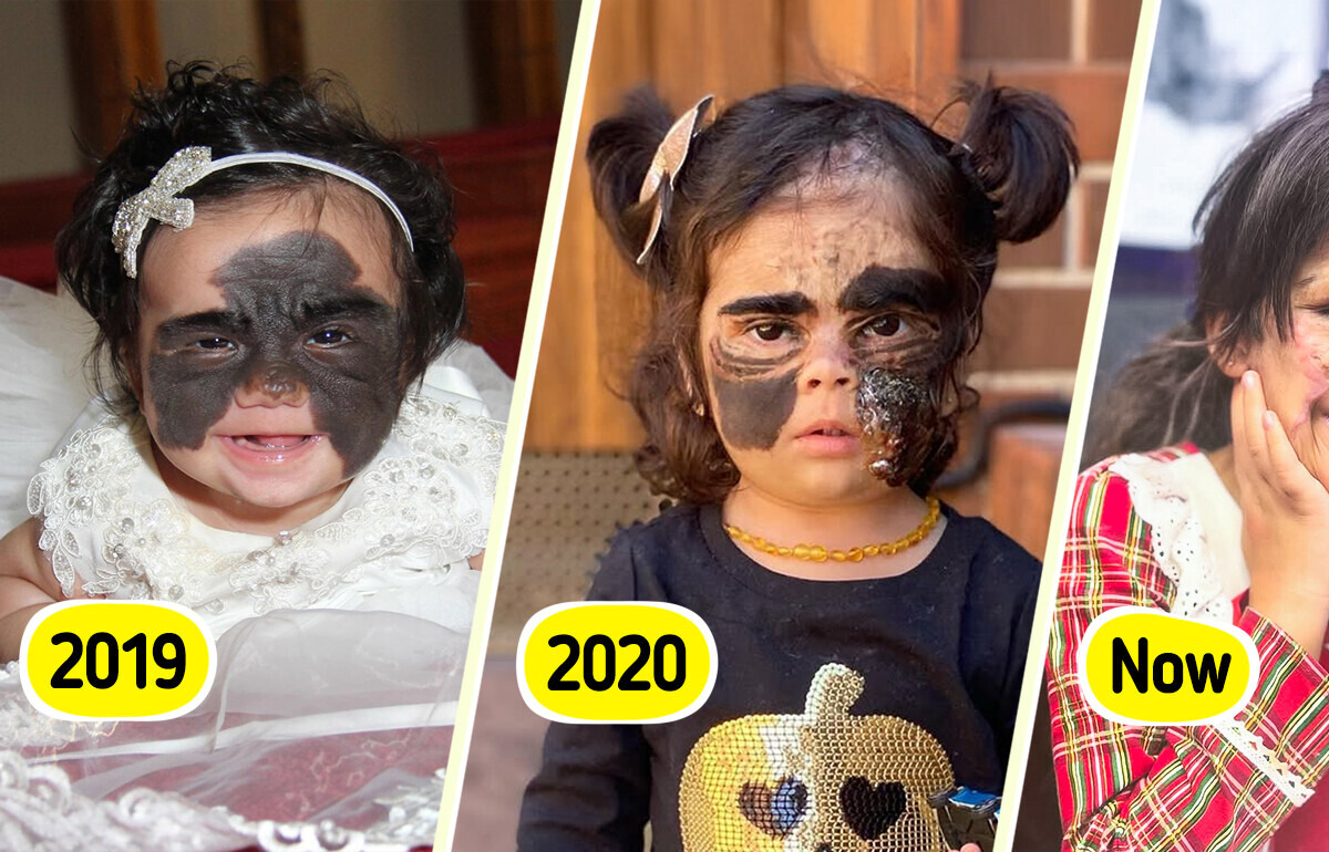 Girl Was Called “Monster” for Her “Batman” Birthmark — Now She Looks Completely Unrecognizable Girl Was Called “Monster” for Her “Batman” Birthmark — Now She Looks Completely Unrecognizable