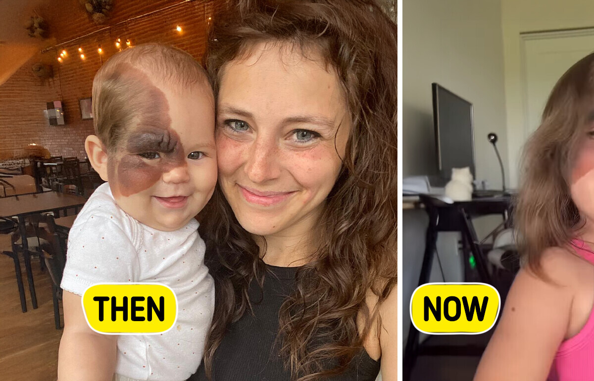 Mom Turns Daughter’s Rare Birthmark Into a Beautiful Superpower Mom Turns Daughter’s Rare Birthmark Into a Beautiful Superpower