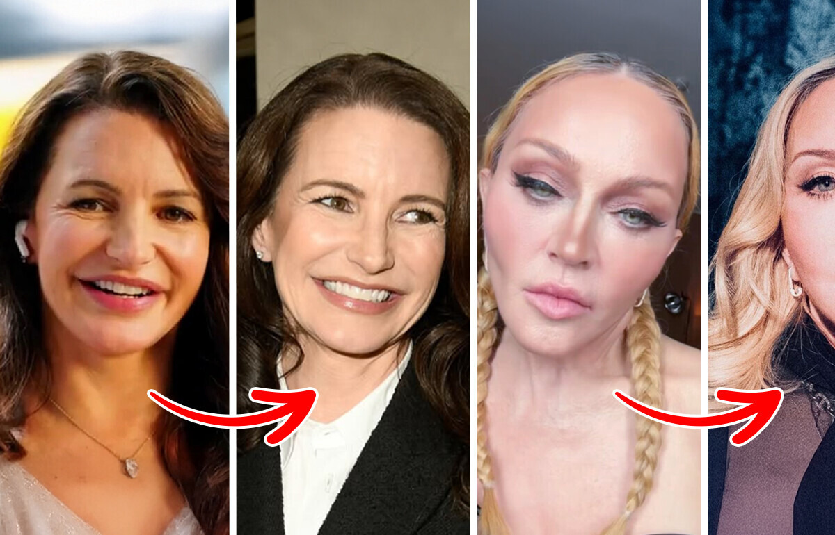 10 Celebrities Who Removed Fillers and Left Everyone Speechless 10 Celebrities Who Removed Fillers and Left Everyone Speechless