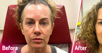 Woman Turns to Botox as She Dreams to Look Like Her Younger Self, and It Seems to Work