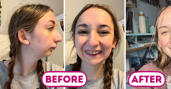 Young Woman Reveals Stunning Jaw Surgery Results That Leave People Speechless