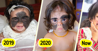 Girl Was Called “Monster” for Her “Batman” Birthmark — Now She Looks Completely Unrecognizable