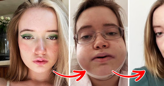 Singer Travels 24 Hours for Jaw Surgery and Shocks Everyone With the Result