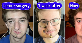 Lukas' Journey with Parry-Romberg Syndrome and the Transformation You Have to See