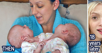 Lucky Story of Conjoined Twins Who Were Separated Just Being 6 Months Old and Now They Are Still Together