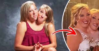 “I’m Just Confused!” One of the Famous Conjoined Twins Got Married, Sparking Heated Controversy