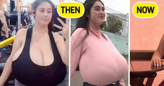 10kg Breasts Forced a 22-Year-Old Student Into Life-Changing Surgery