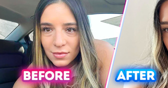 17 People Who Chose Plastic Surgery and Feel Happier Than Ever