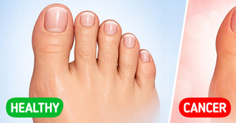 5 Sneaky Toenail Clues That May Point to Hidden Health Problems