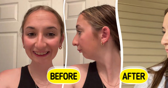 Double Jaw Surgery Took 4 Hours... and 41M People Can’t Believe the Results!