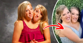 “I’m Just Confused!” One of the Famous Conjoined Twins Got Married, Sparking Heated Controversy