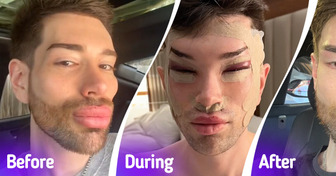 A Man Removes Facial Fillers After Multiple Beauty Procedures, Stunning People with Remarkable Results