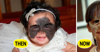 Girl With Batman Mask Birthmark Was Called a Monster Now She Is Absolutely Enchanting