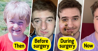 Meet Lukas: His Journey with Parry-Romberg Syndrome and How He Looks Today