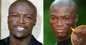 Seal Speaks Out on «Traumatizing» Scars on His Face and Their Origins