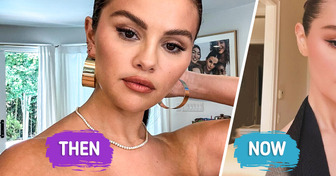 “She Got Filler and Cheek Implant!” Selena Gomez’s Stunning New Look Has Everyone Talking